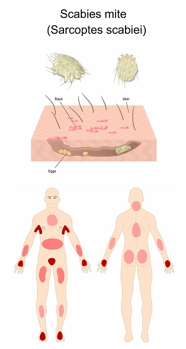 Scabies Infographics
